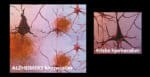 Aldersdemens, sykelige forandringer i hjernen 4 Alzheimers sykdom, gåten som ikke er løst